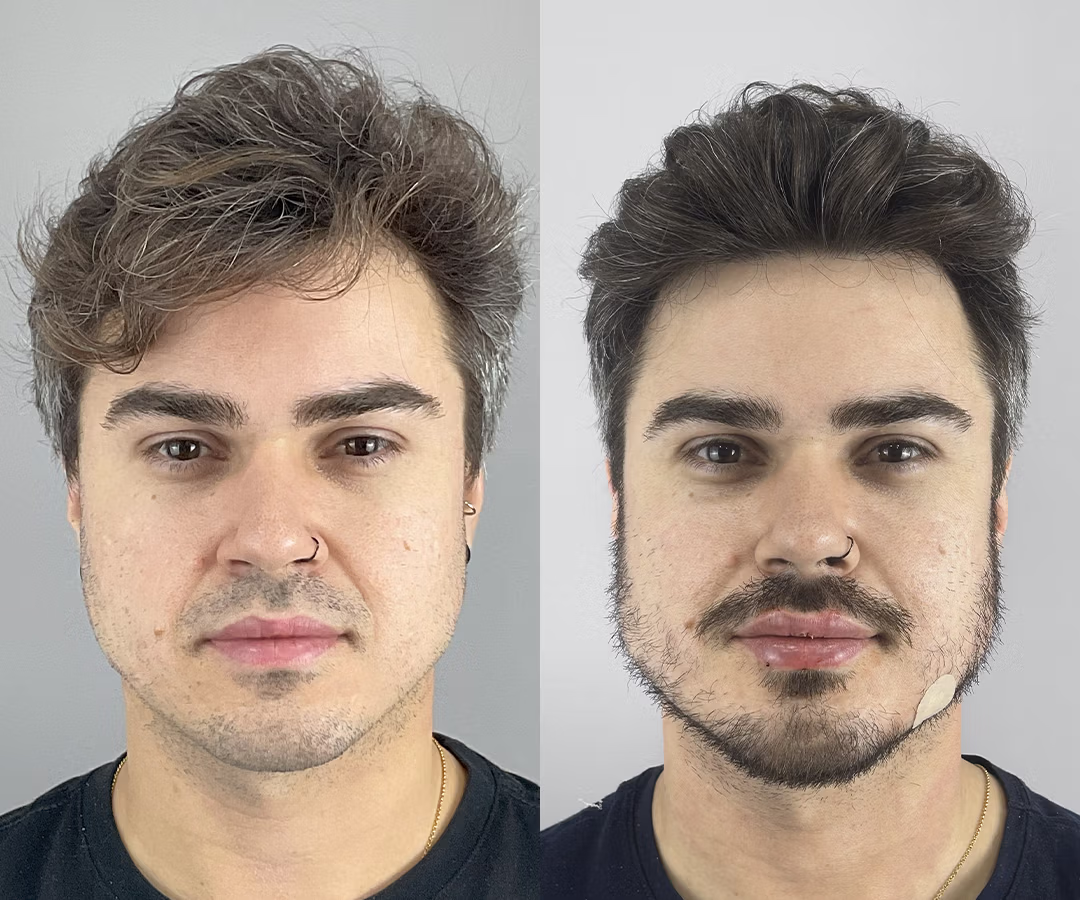 Antes e depois luiz 2