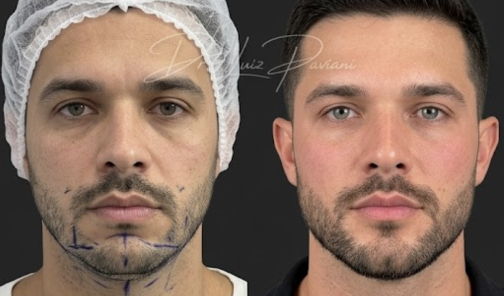 Resultado de harmonização facial masculina